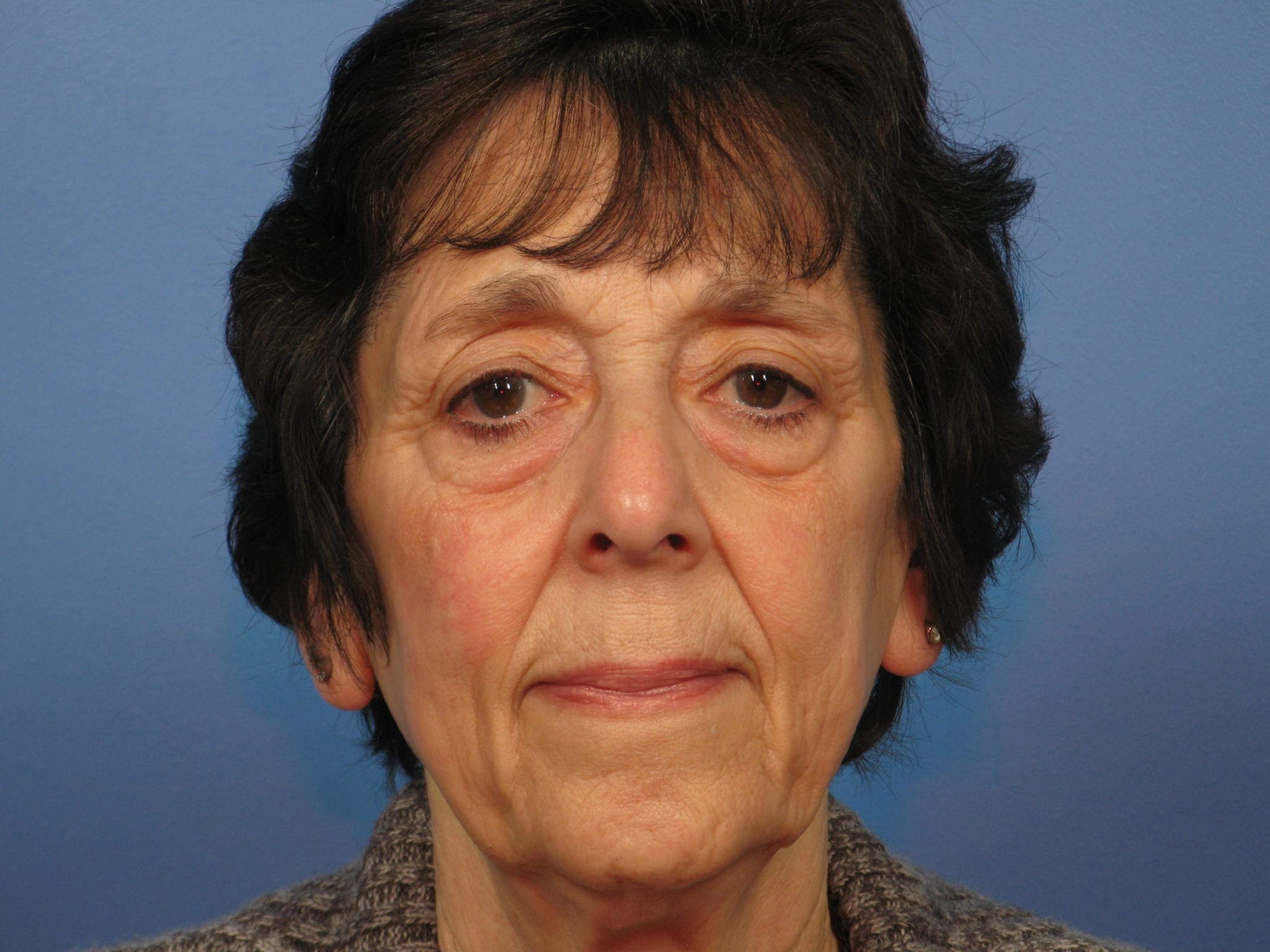 Upper and Lower Blepharoplasty