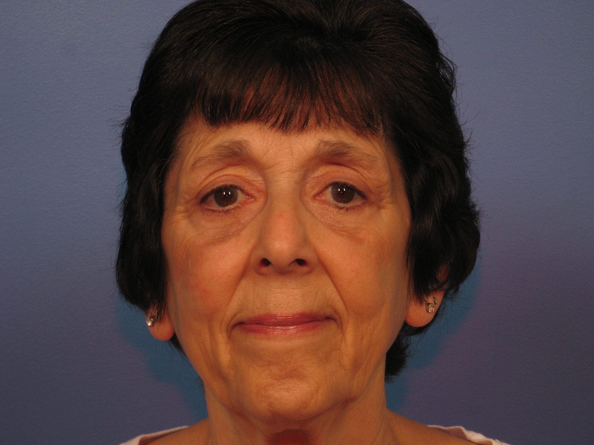 Upper and Lower Blepharoplasty
