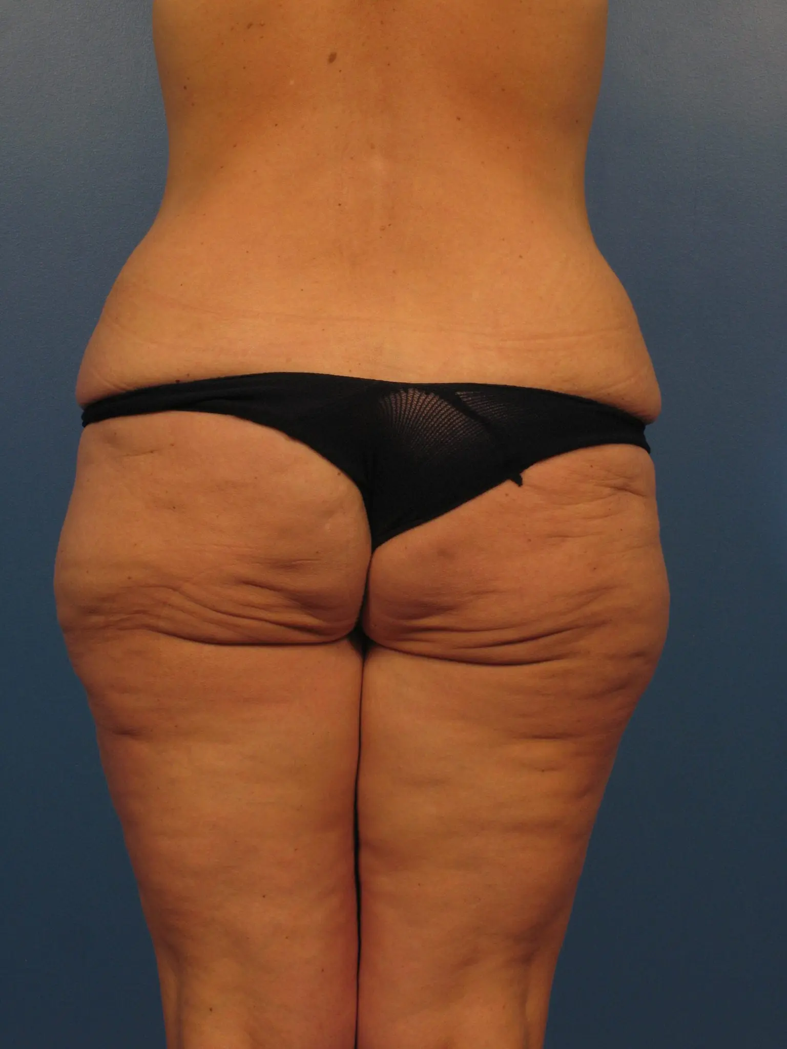 After: Surgery after major weight loss, Belt Lipectomy