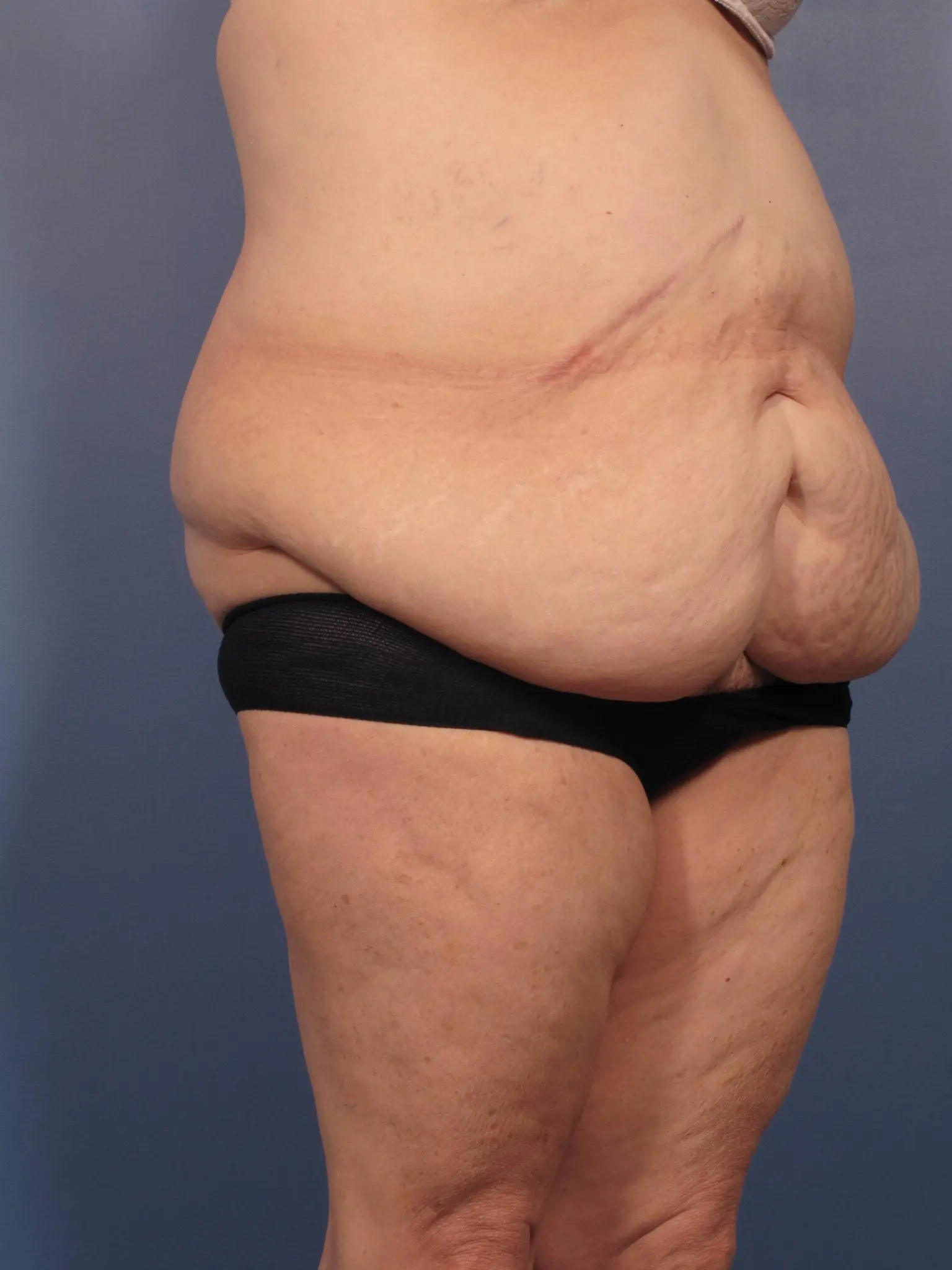 Before and After Photos After Major Weight Loss, Tummy Tuck