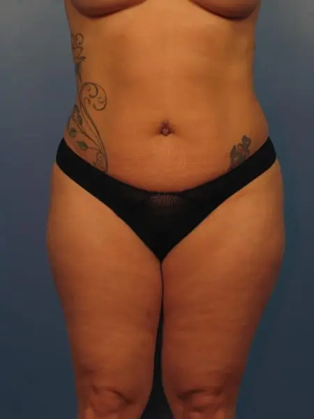 Before - Liposuction