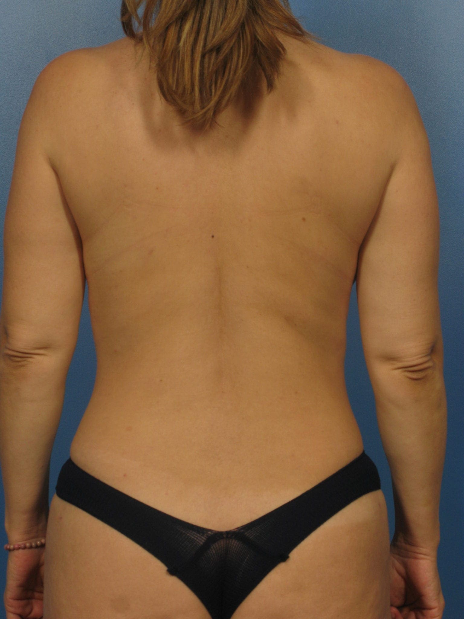 After Liposuction Bra Roll
