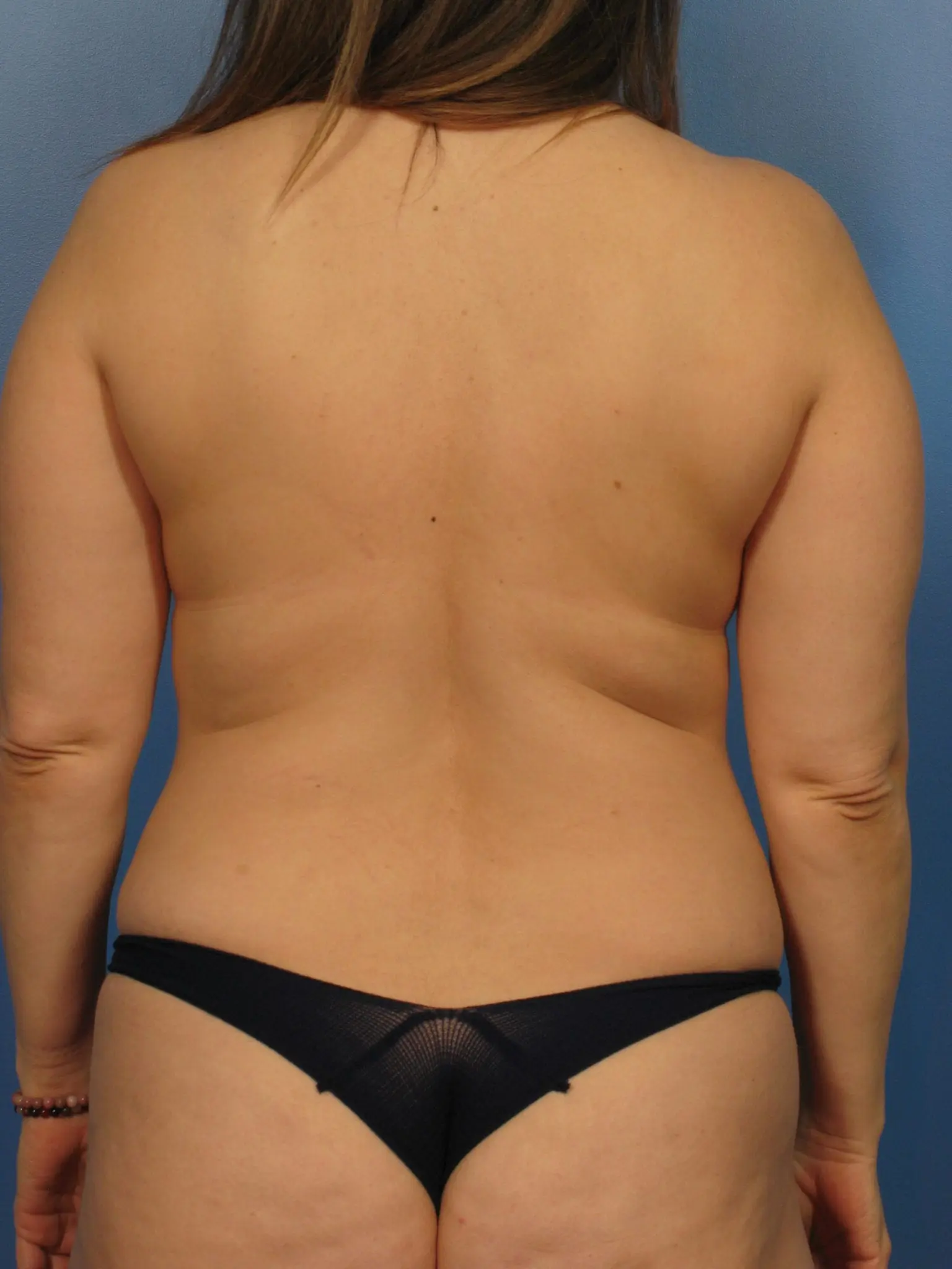 Before Liposuction Bra Roll