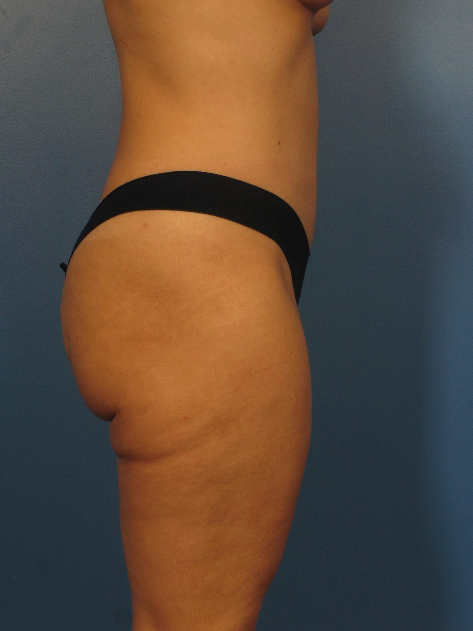 After a Tummy Tuck