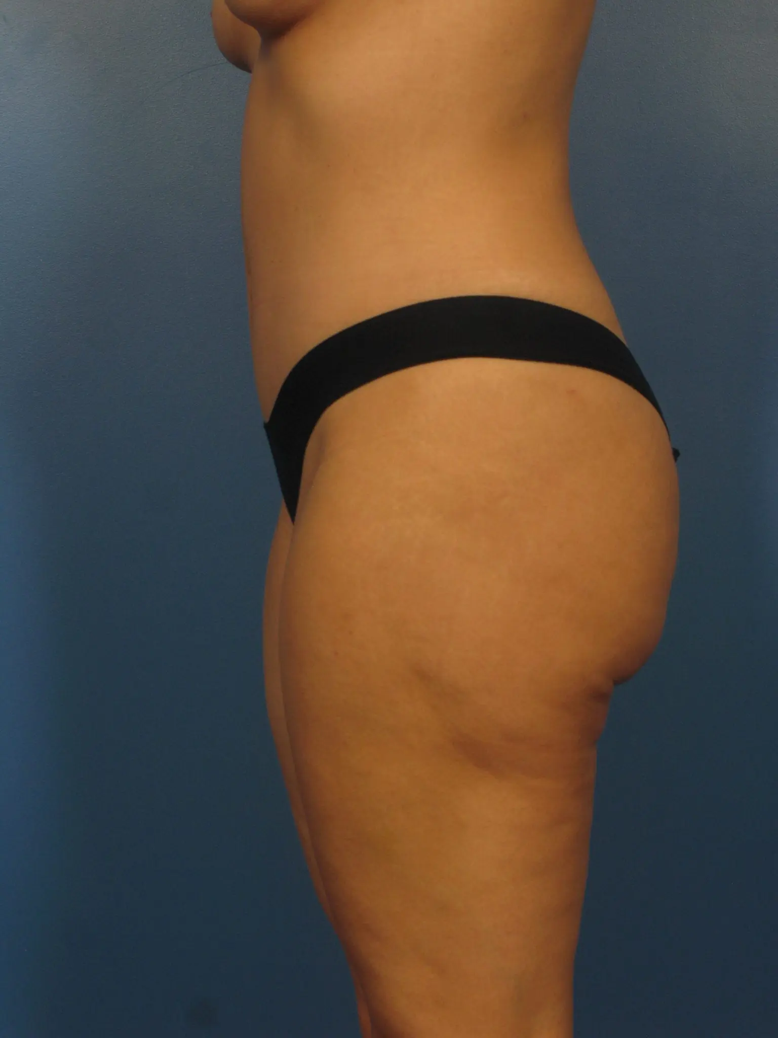 After a Tummy Tuck