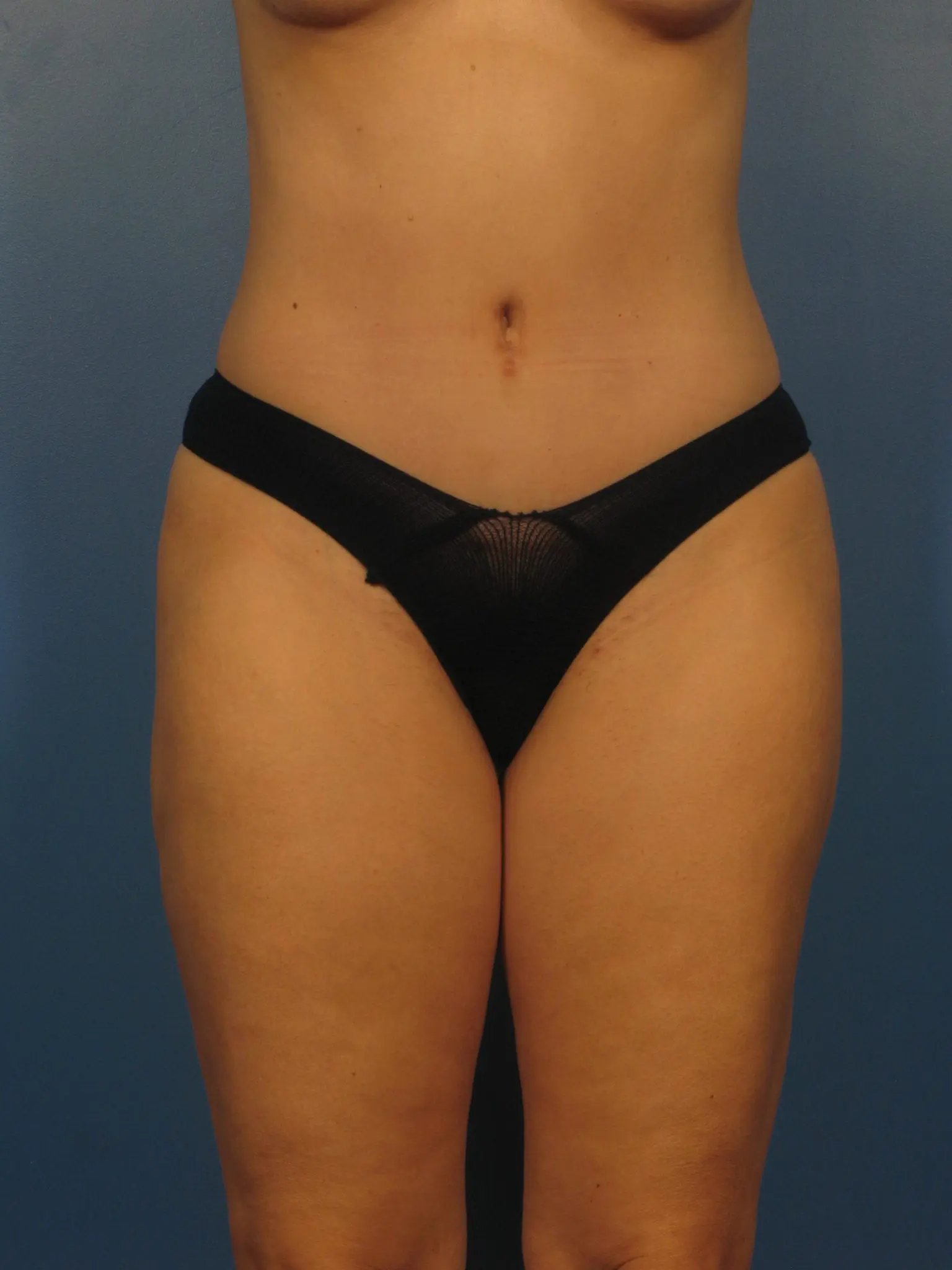 After a Tummy Tuck