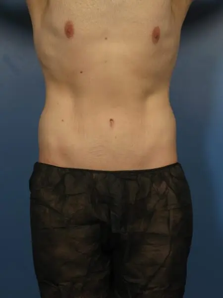 After: Extended Tummy Tuck