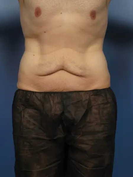 Before: Extended Tummy Tuck