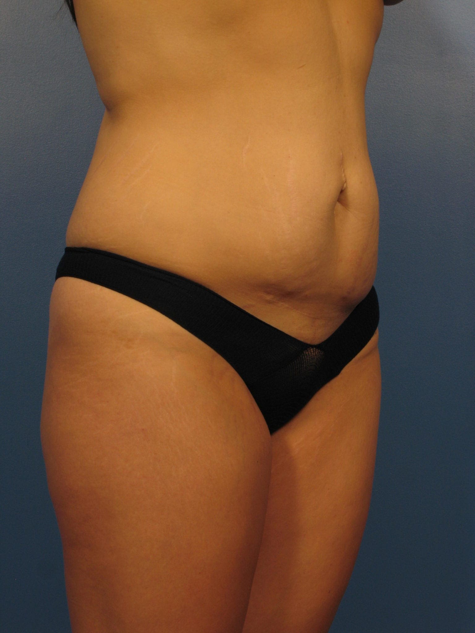 Before: Tummy Tuck