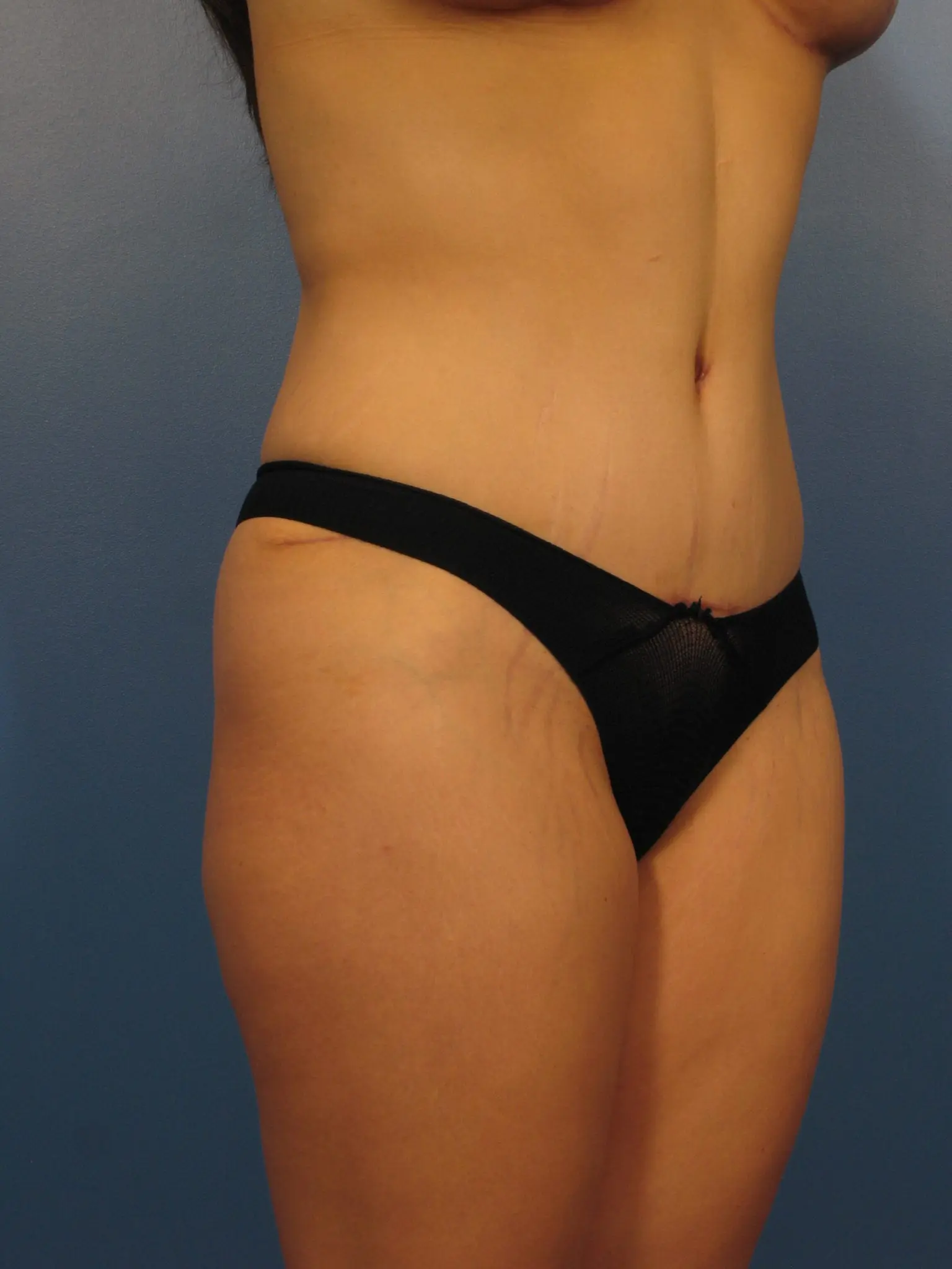 After: Tummy Tuck